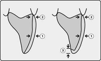 Facings